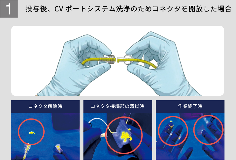 1 投与後、CVポートシステム洗浄のためコネクタを開放した場合