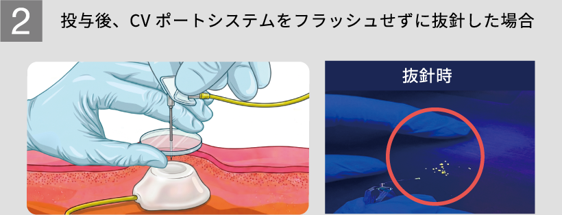 2 投与後、CVポートシステムをフラッシュせずに抜針した場合